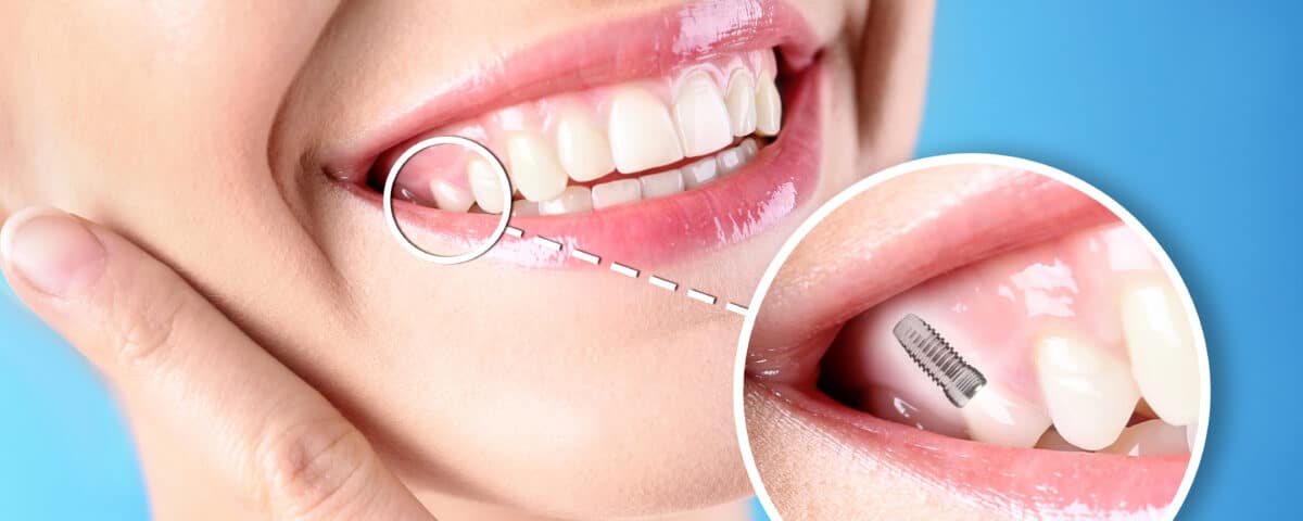 3-reasons-to-consider-dental-implants-from-premier-dentistry