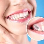 3-reasons-to-consider-dental-implants-from-premier-dentistry