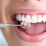 5-things-to-know-about-adult-fluoride-treatments