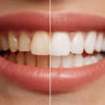brighten-your-smile-professional-teeth-whitening-at-premier-dentistry-of-eagle