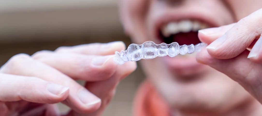 can-i-get-invisalign-if-im-an-adult