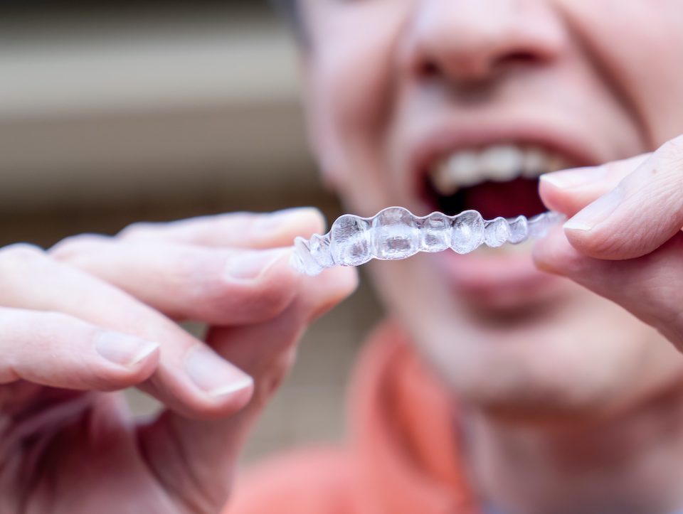 can-i-get-invisalign-if-im-an-adult