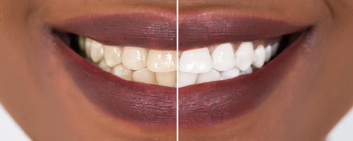 debunking-teeth-whitening-myths