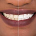 debunking-teeth-whitening-myths