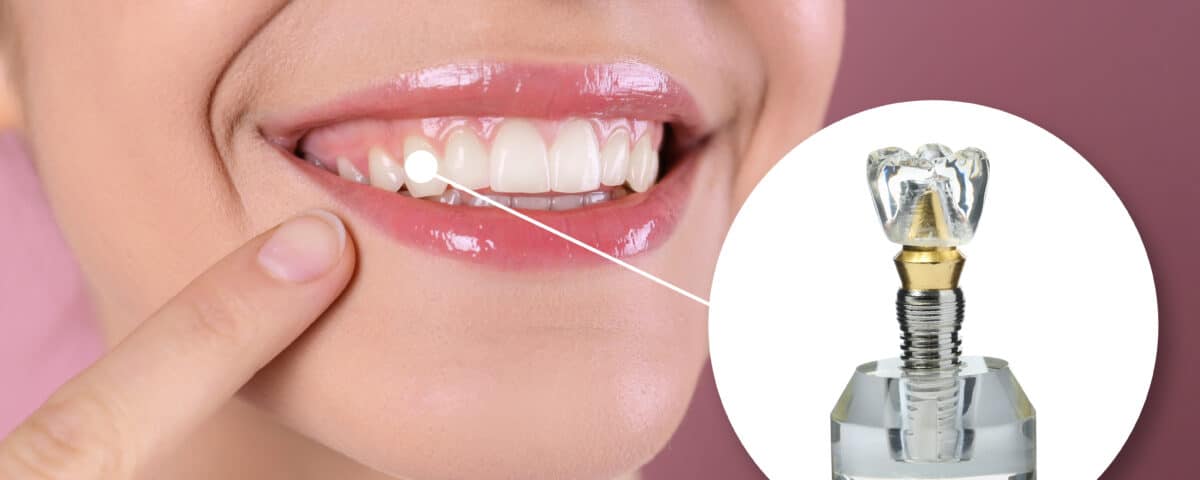dental-implants-a-lasting-solution-for-missing-teeth