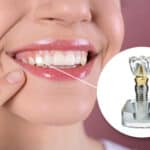 dental-implants-a-lasting-solution-for-missing-teeth