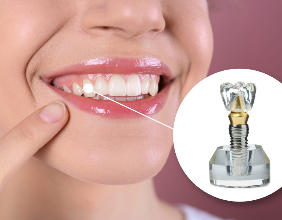 dental-implants-a-lasting-solution-for-missing-teeth