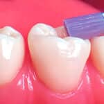 how-dental-sealants-protect-more-than-just-kids-teeth