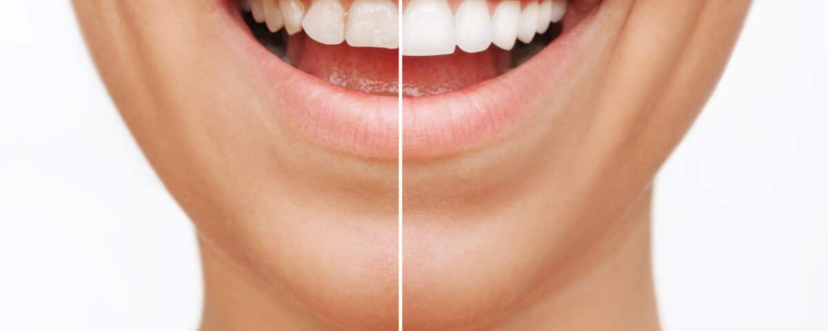 how-dental-veneers-can-get-you-the-smile-of-your-dreams