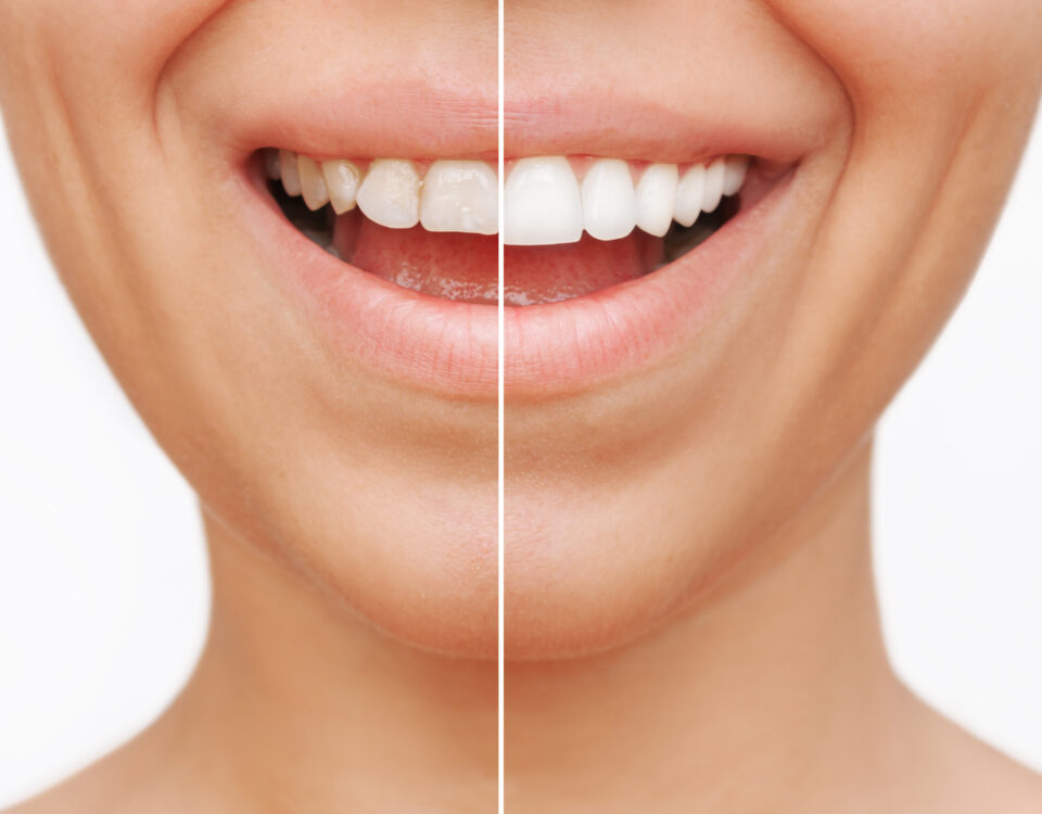 how-dental-veneers-can-get-you-the-smile-of-your-dreams