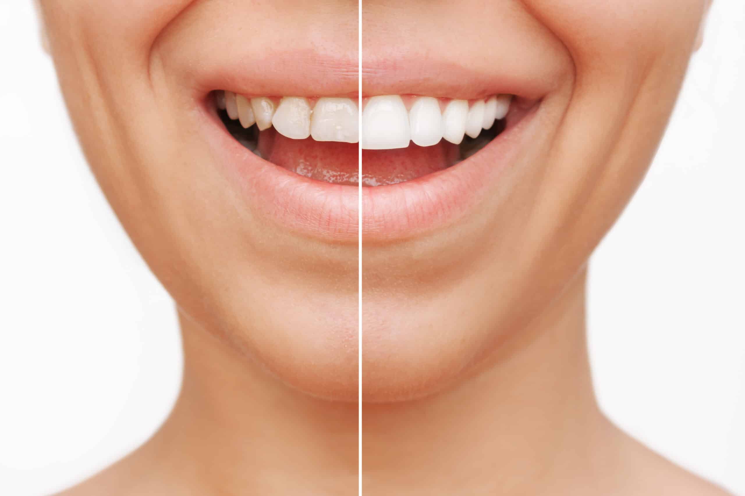 how-dental-veneers-can-get-you-the-smile-of-your-dreams