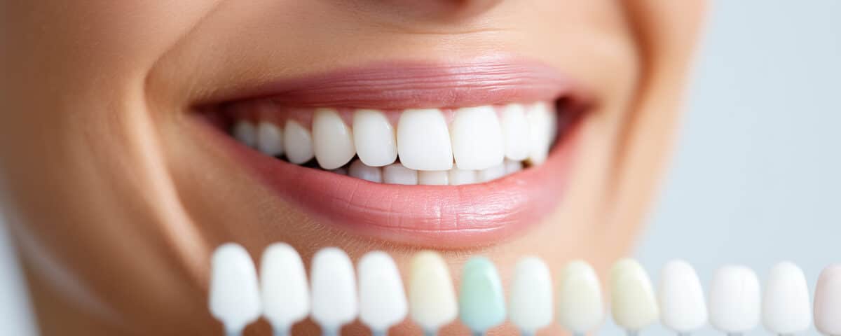 how-professional-teeth-whitening-can-brighten-your-smile-for-spring