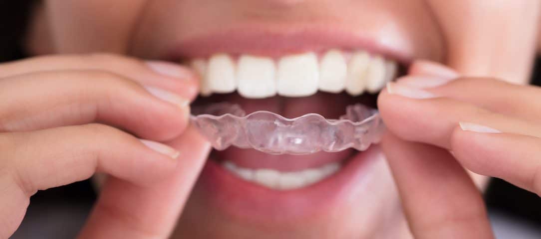 teeth-grinding-and-more-why-you-may-need-a-night-guard