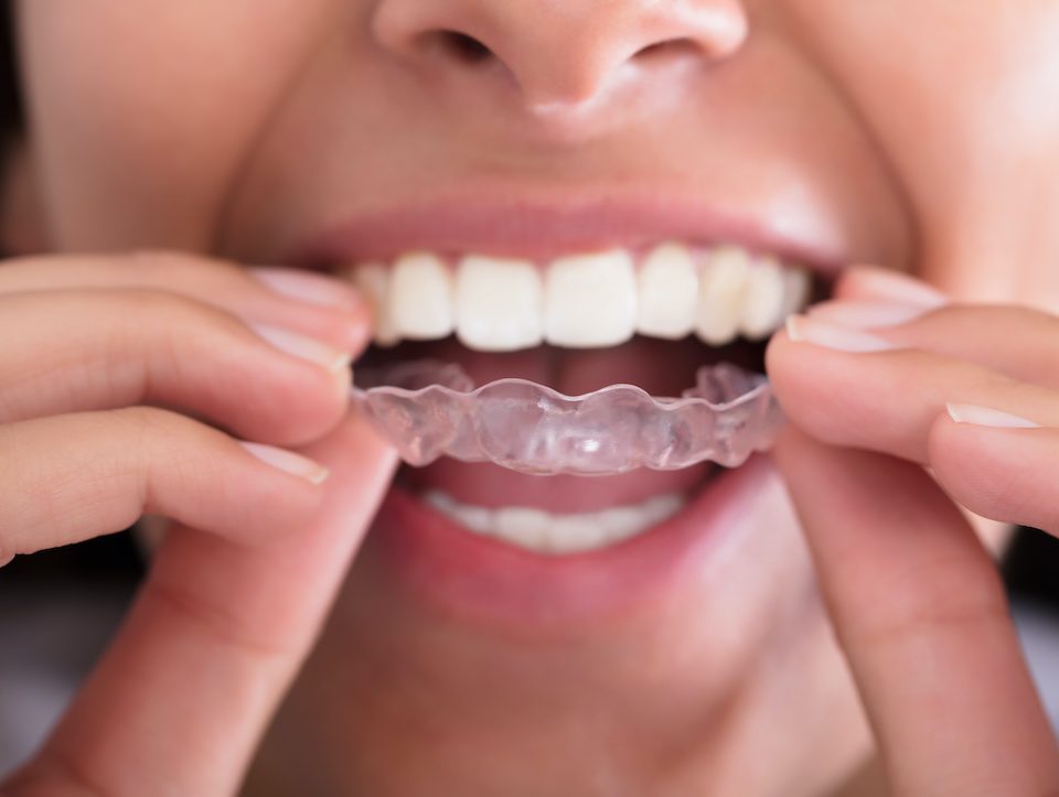 teeth-grinding-and-more-why-you-may-need-a-night-guard