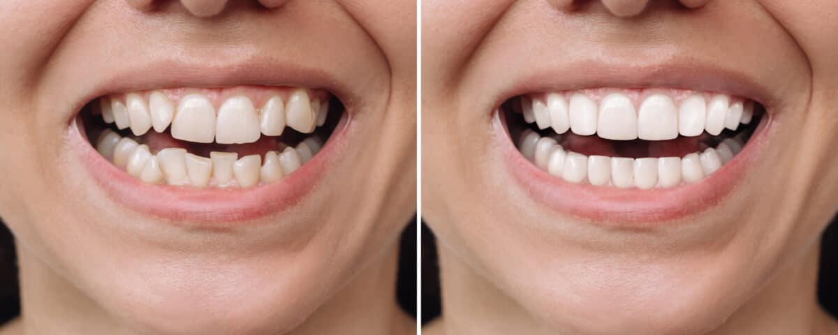 the-benefits-of-porcelain-veneers-for-a-smile-makeover
