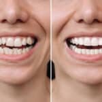 the-benefits-of-porcelain-veneers-for-a-smile-makeover