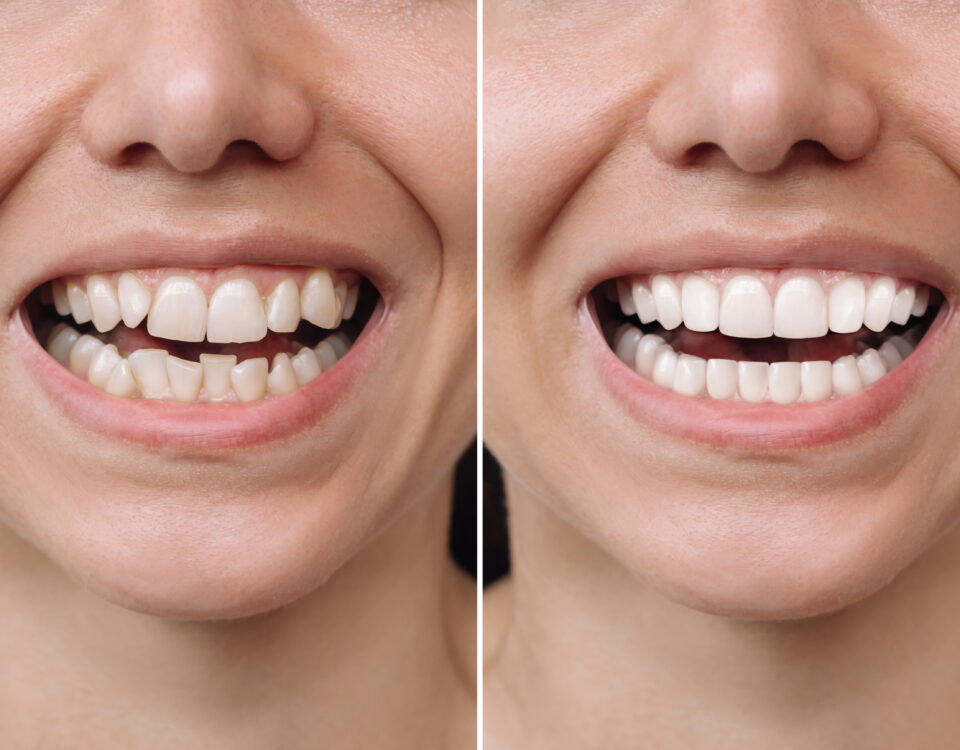 the-benefits-of-porcelain-veneers-for-a-smile-makeover