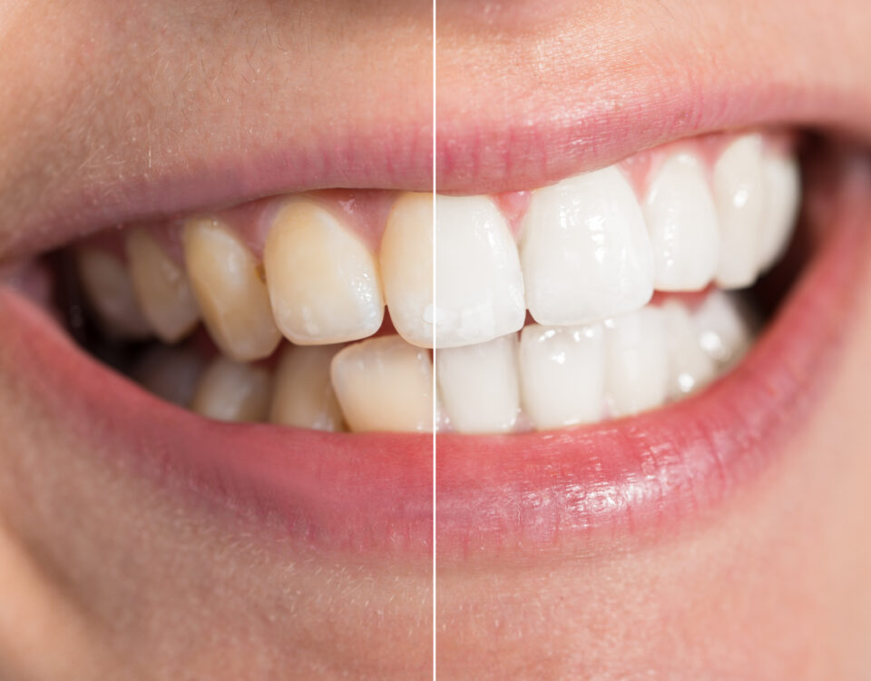 the-different-types-of-teeth-stains-and-how-to-remove-them
