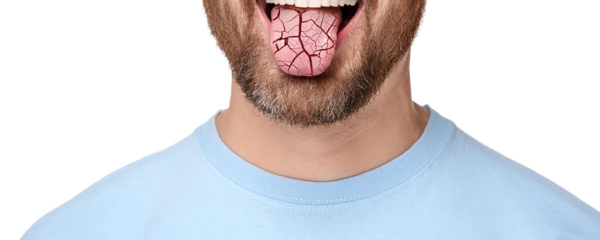 the-symptoms-of-xerostomia-and-how-to-treat-it