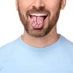 the-symptoms-of-xerostomia-and-how-to-treat-it