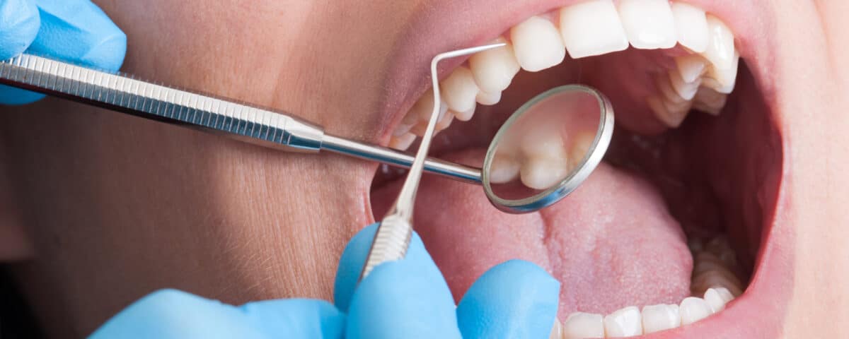 understanding-and-treating-cavities-at-premier-dentistry-of-eagle