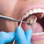 understanding-and-treating-cavities-at-premier-dentistry-of-eagle