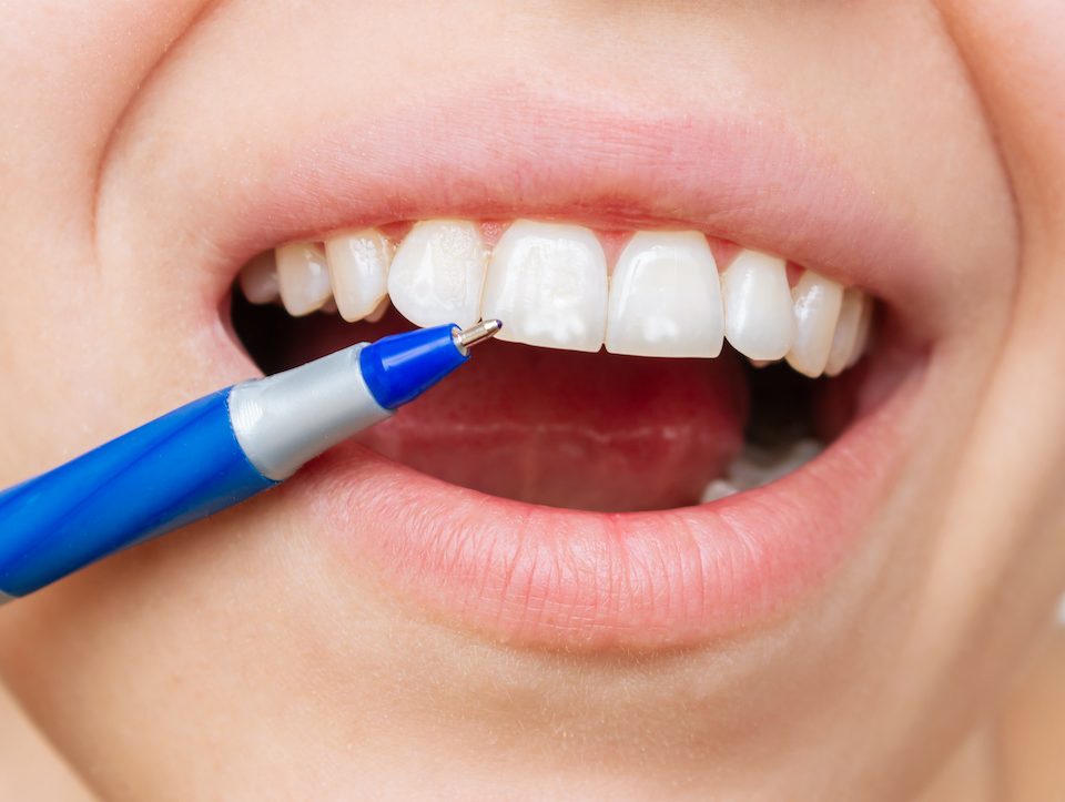 white-spots-on-teeth-causes-treatment-and-prevention