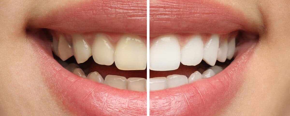 why-do-teeth-get-stained-and-what-can-you-do-about-it