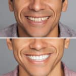 why-summer-is-the-perfect-time-for-cosmetic-dentistry-treatments