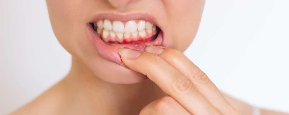 why-you-shouldnt-ignore-bleeding-gums-what-it-means-and-what-you-can-do