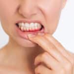 why-you-shouldnt-ignore-bleeding-gums-what-it-means-and-what-you-can-do